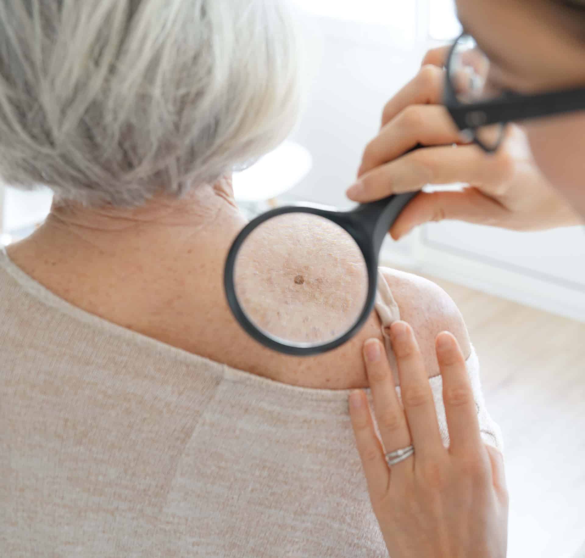 Sid Shah PA-C magnifying a woman's skin during Foreign Body Removal appointment at Halo Skin Institute
