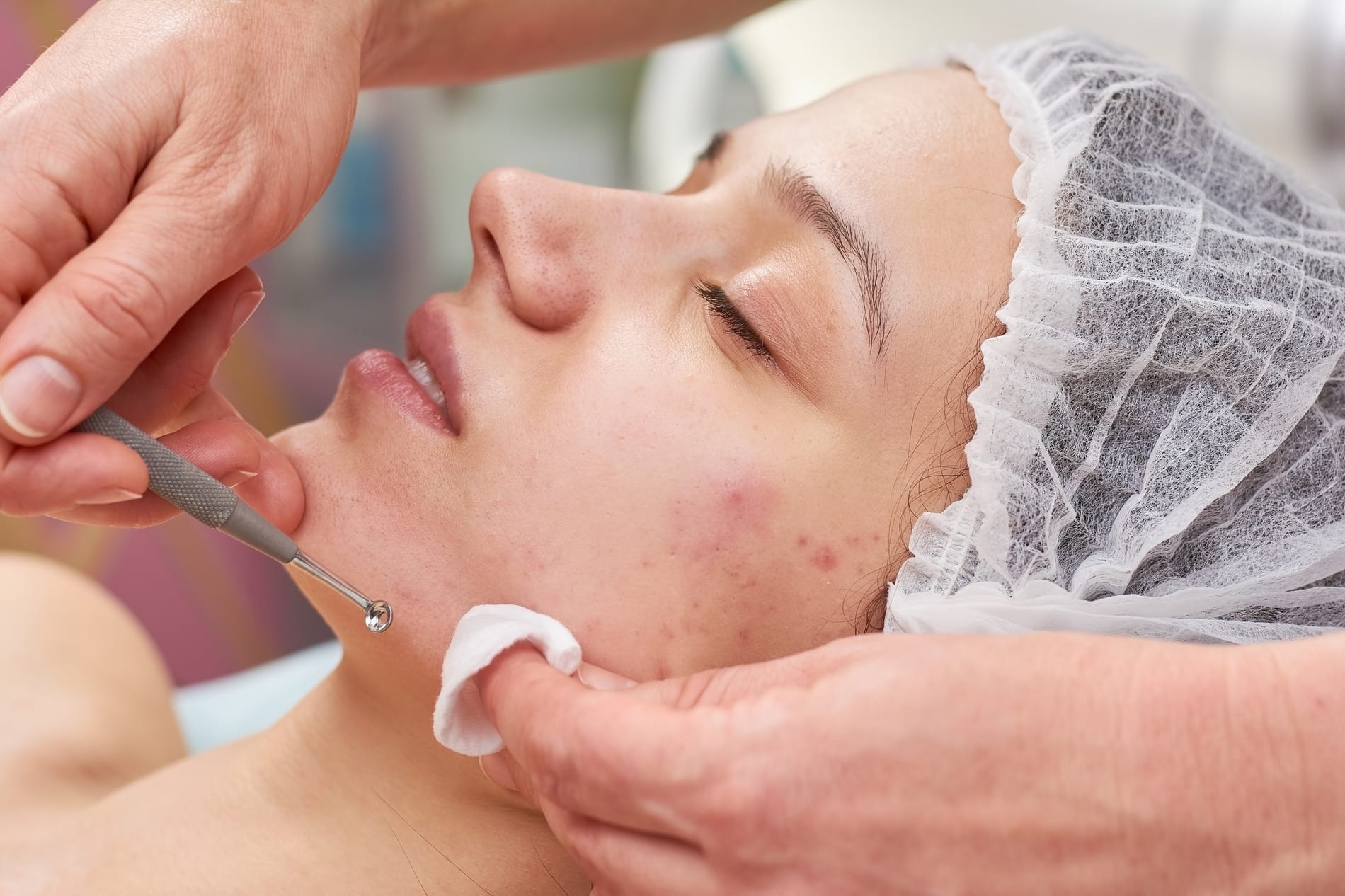 Woman receiving treatment for her acne at Halo Skin Institute