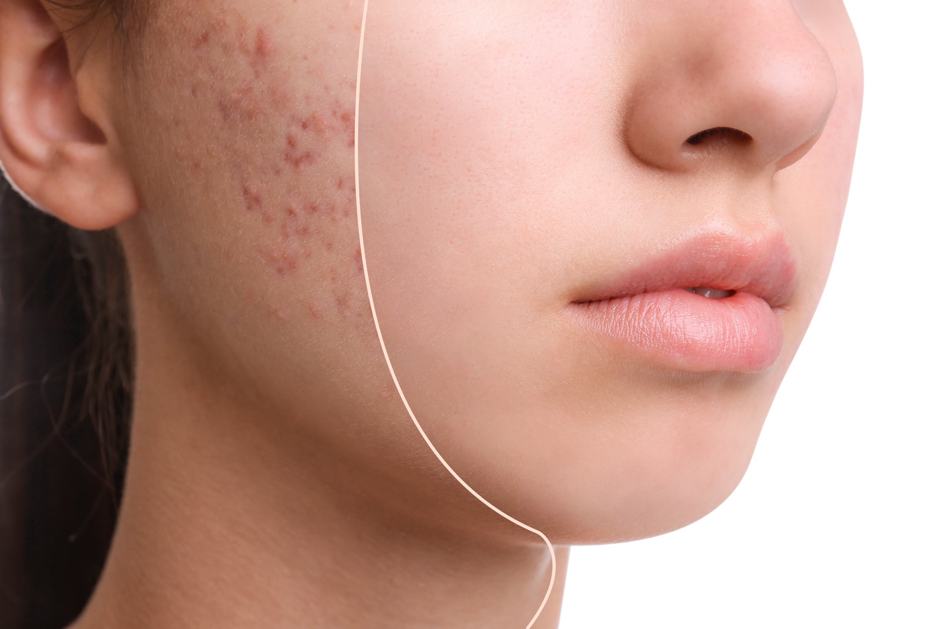 Woman showing before and after acne treatment, her clear skin in Rocklin CA