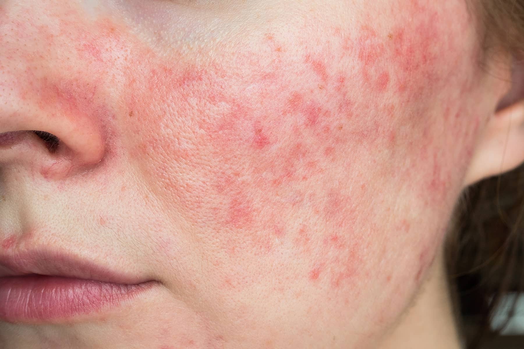 Rosacea doctor in Rocklin, CA