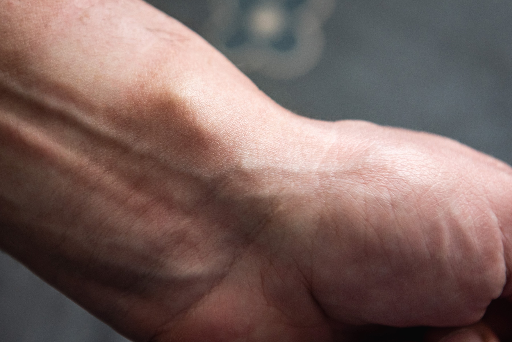 Lipoma surgery in Rocklin, CA