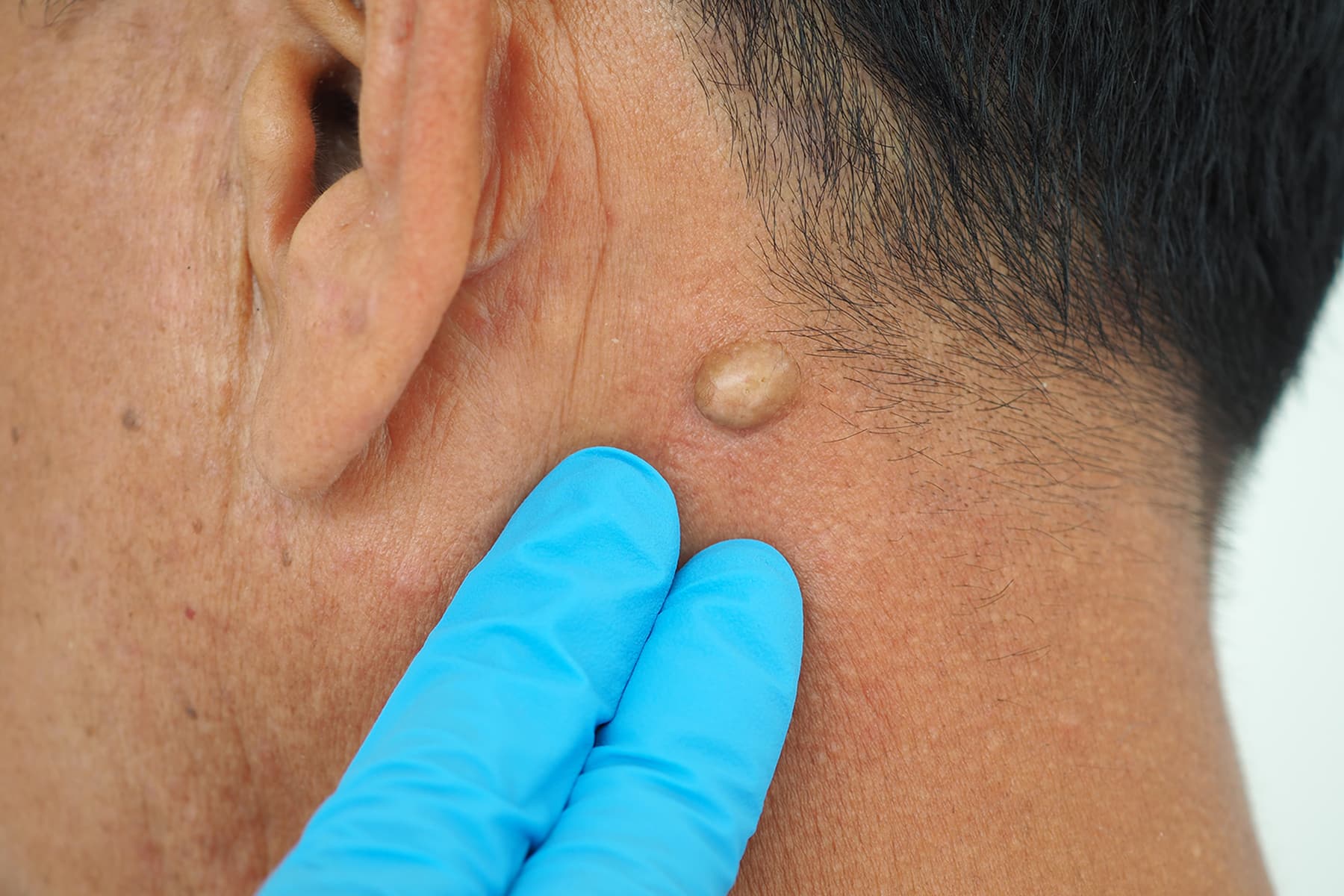 Lipoma doctor in Rocklin, CA