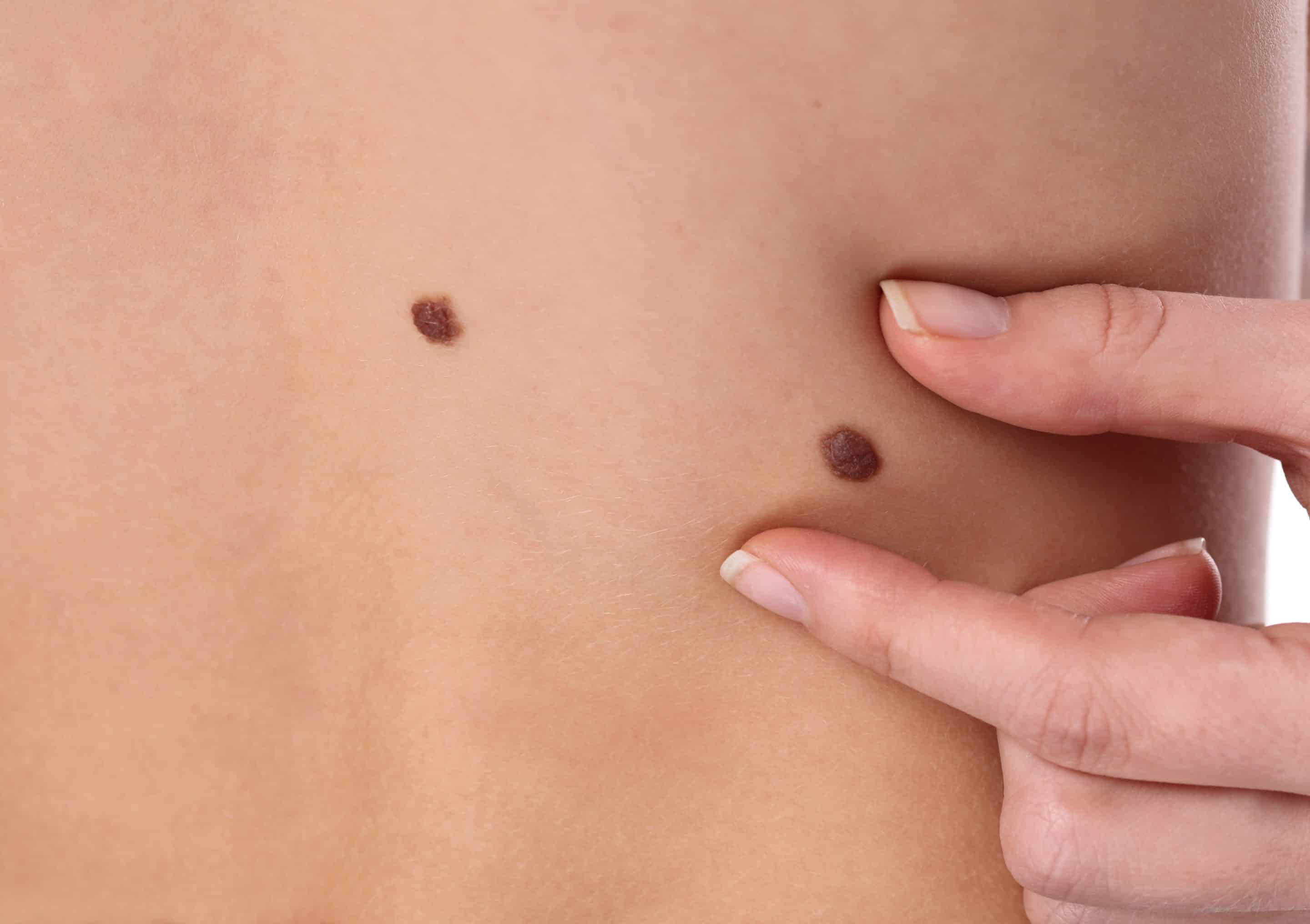 Skin tag doctor near Sacramento, CA