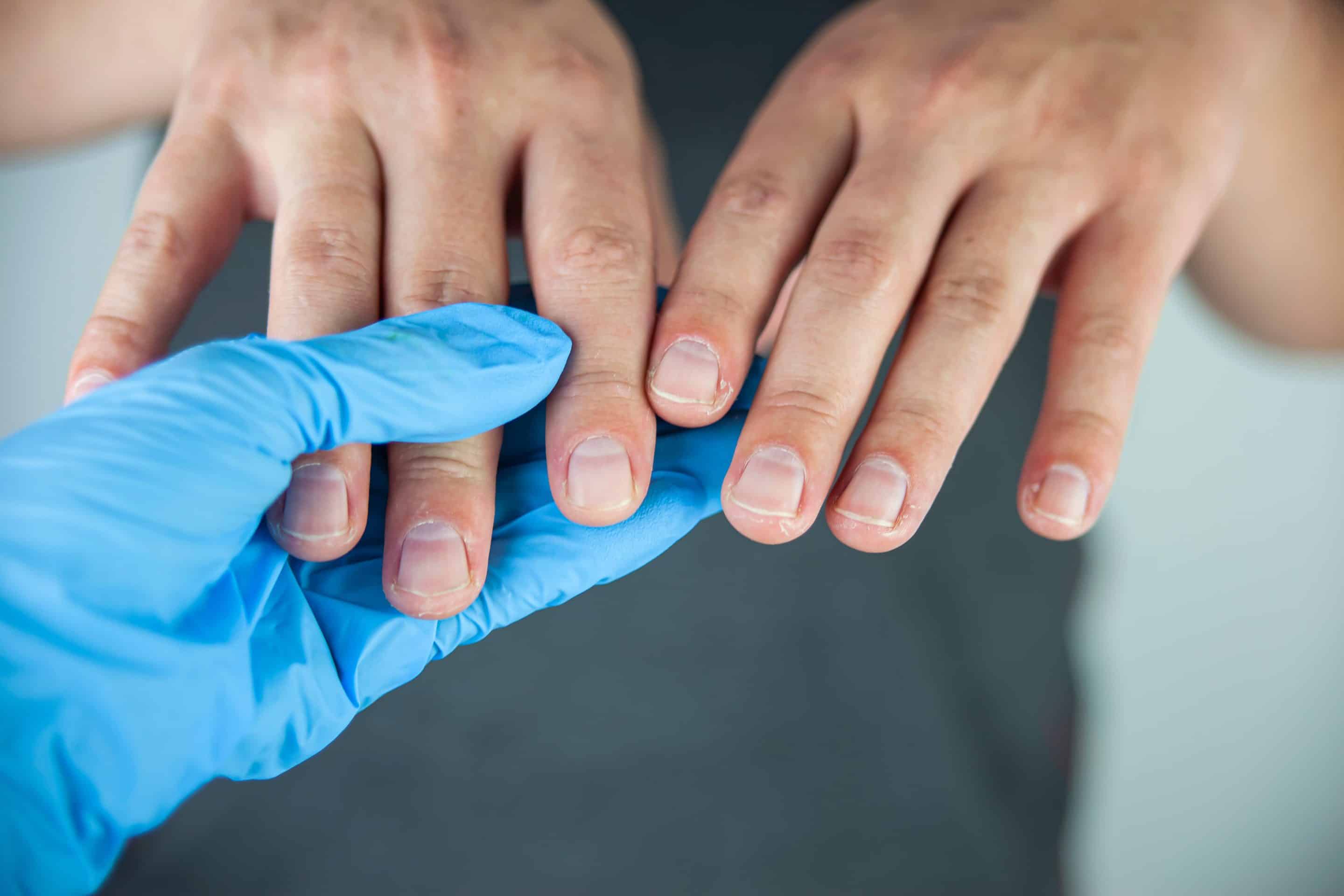 Finger nail fungus treatment near Sacramento, CA