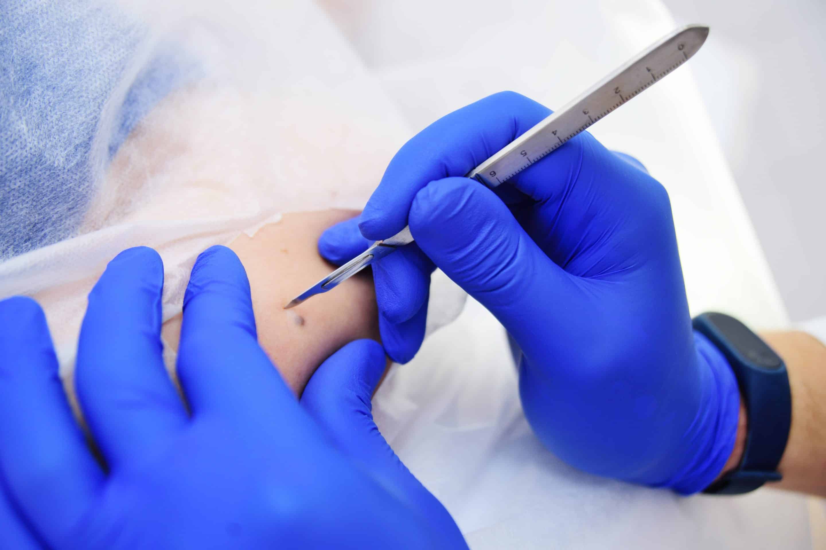 Mole removal doctor in Rocklin and Auburn, CA