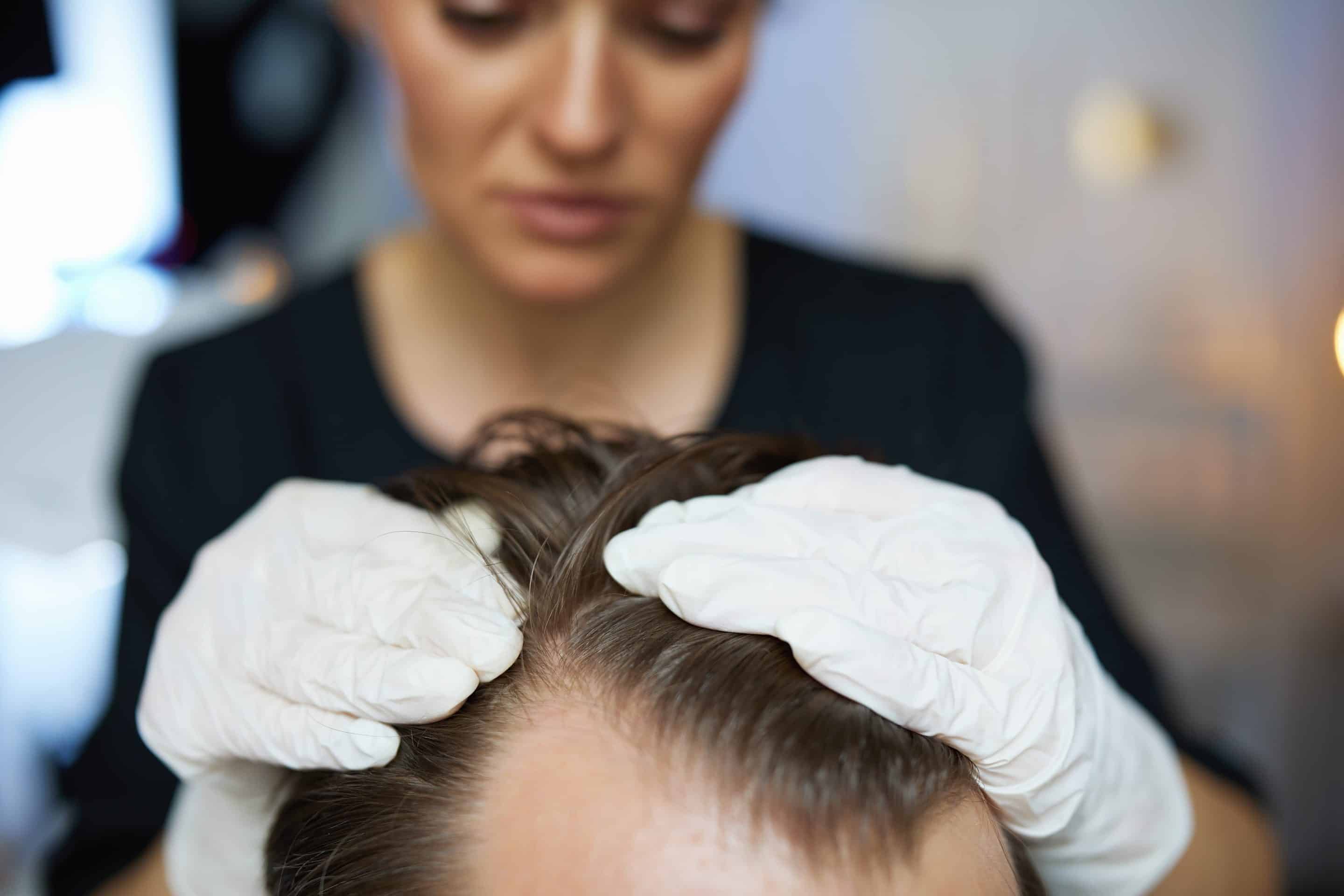 Dandruff appointment in Rocklin, CA