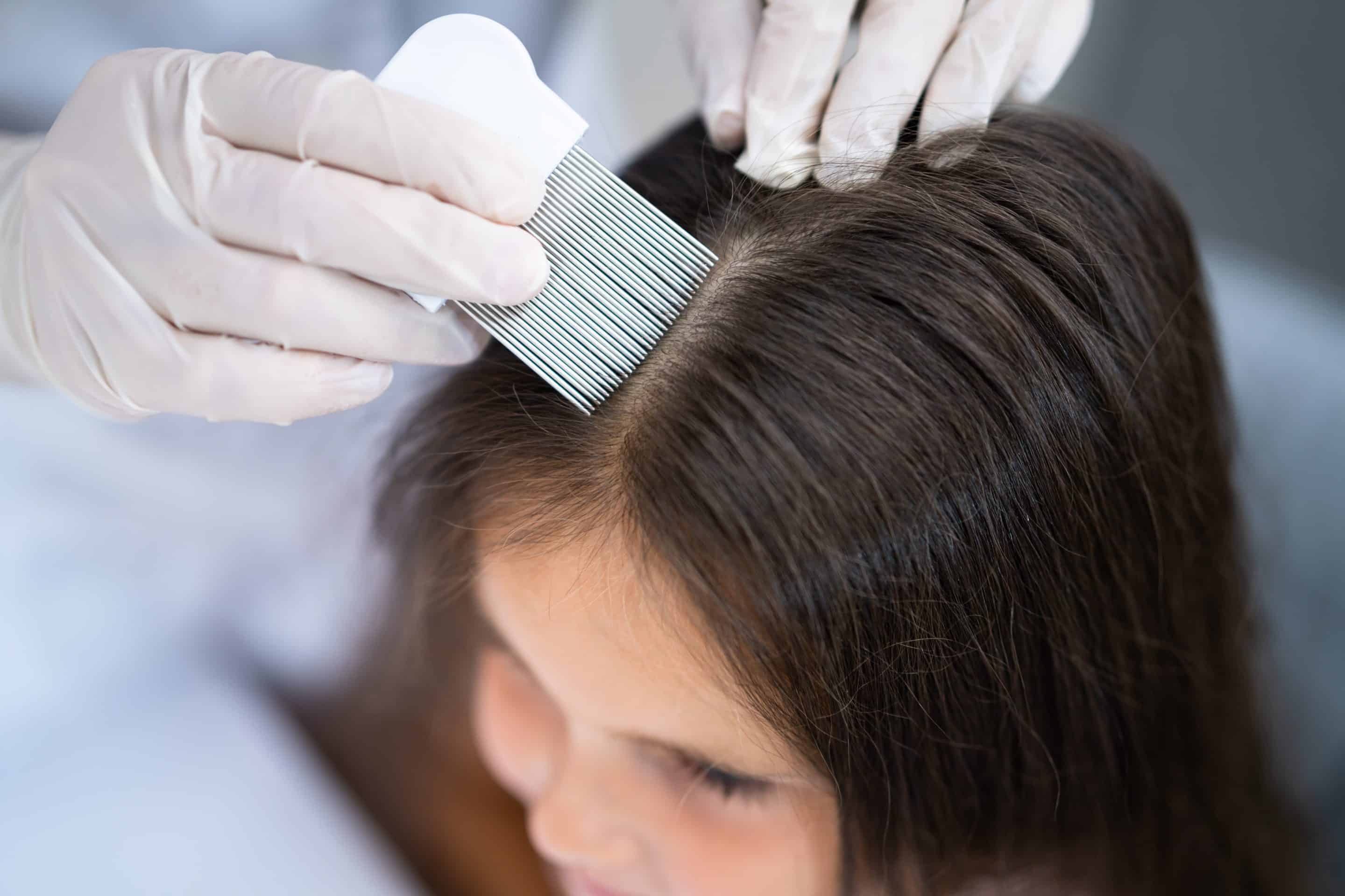 Dandruff doctor near Sacramento, CA