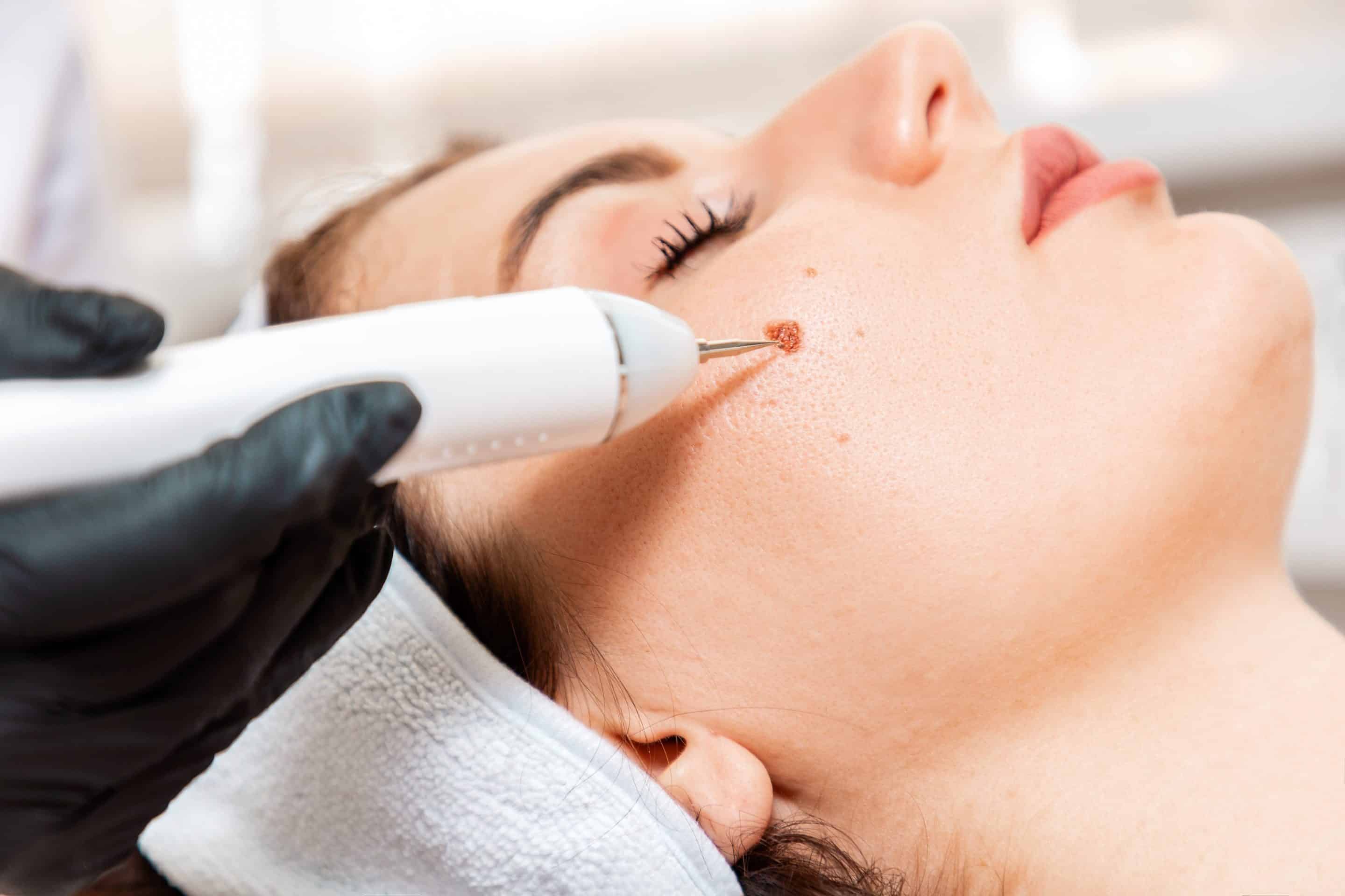 Cosmetic mole removal appointment near Sacramento