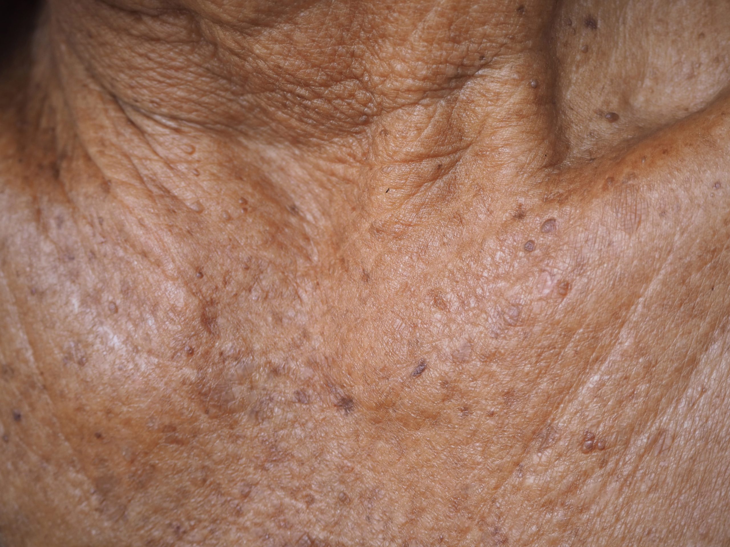 Actinic keratosis treament appointment in Rocklin, CA