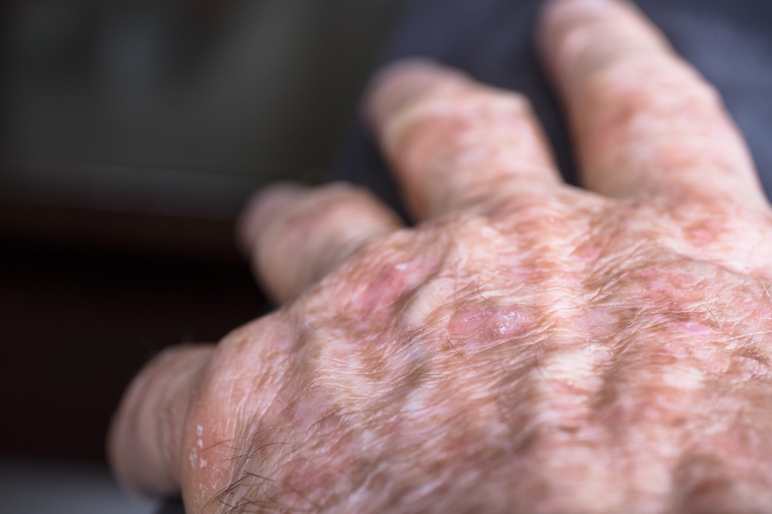 Actinic Keratosis doctor in Auburn, CA