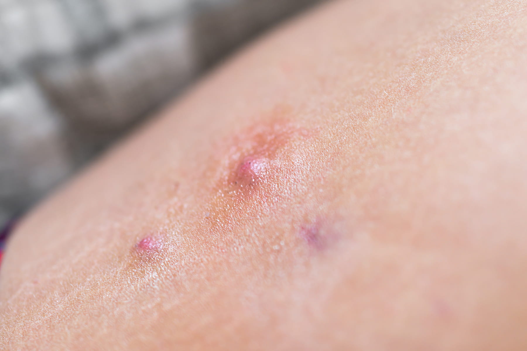 HS treatment in Auburn, CA