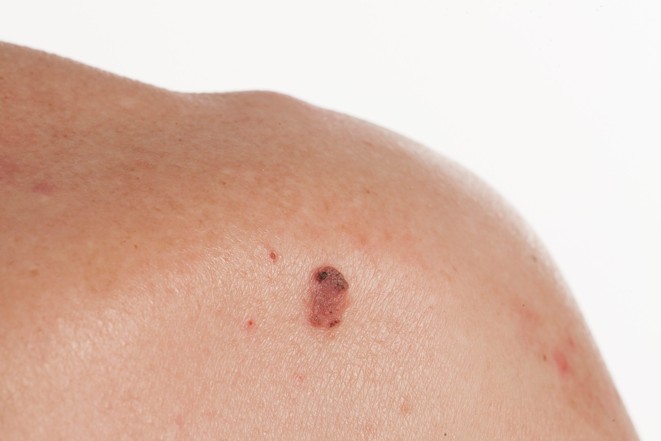 Skin cancer cell doctor in Sacramento Area, California