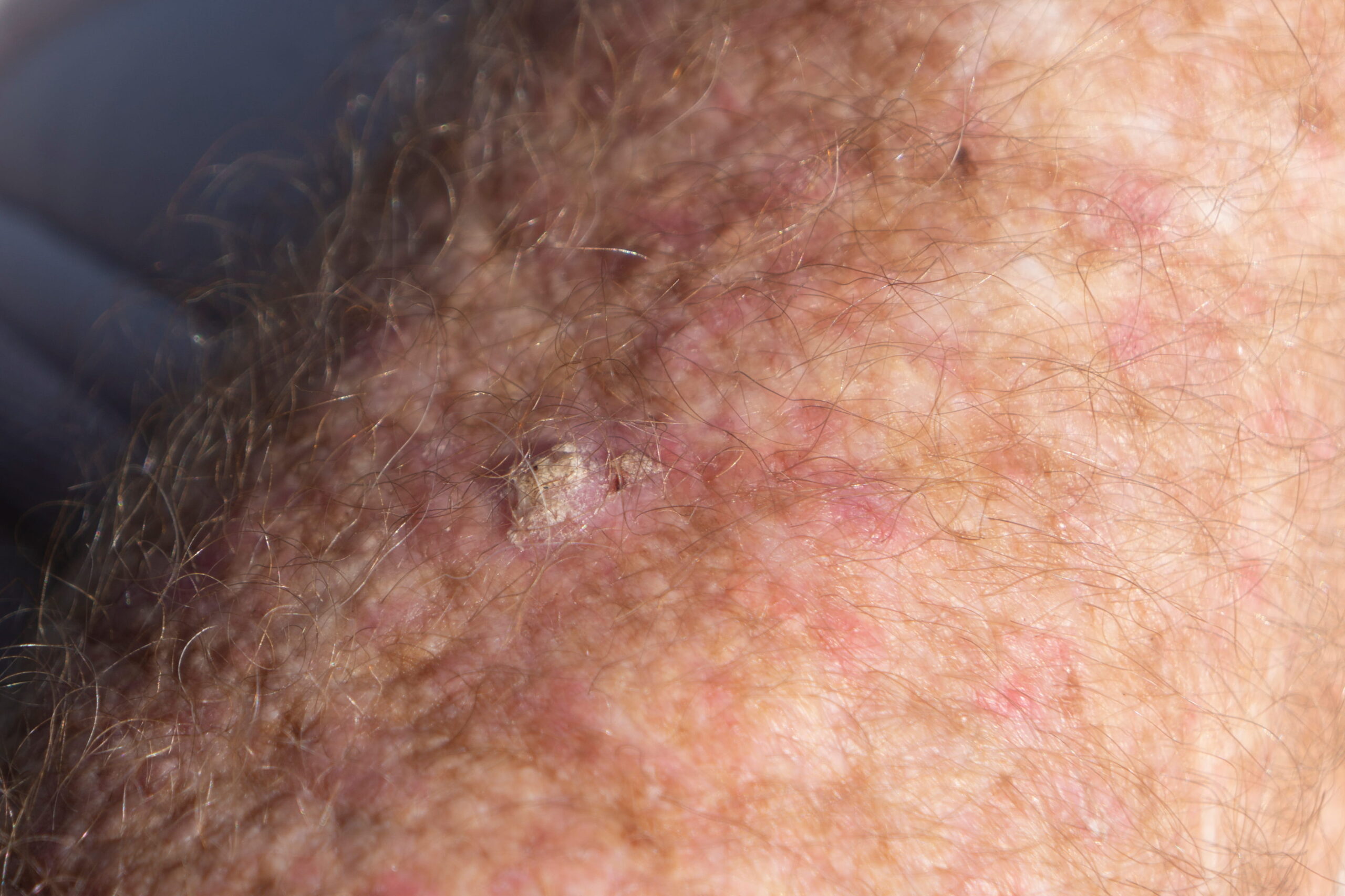 Squamous Cell Carcinoma dermatologist in Sacramento Area
