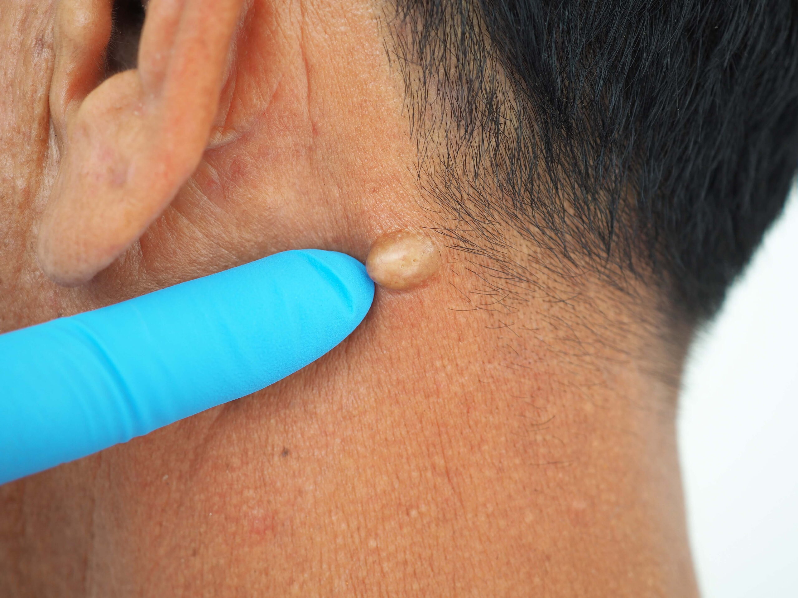 Sebaceous Cyst Consultation in the Sacramento Area