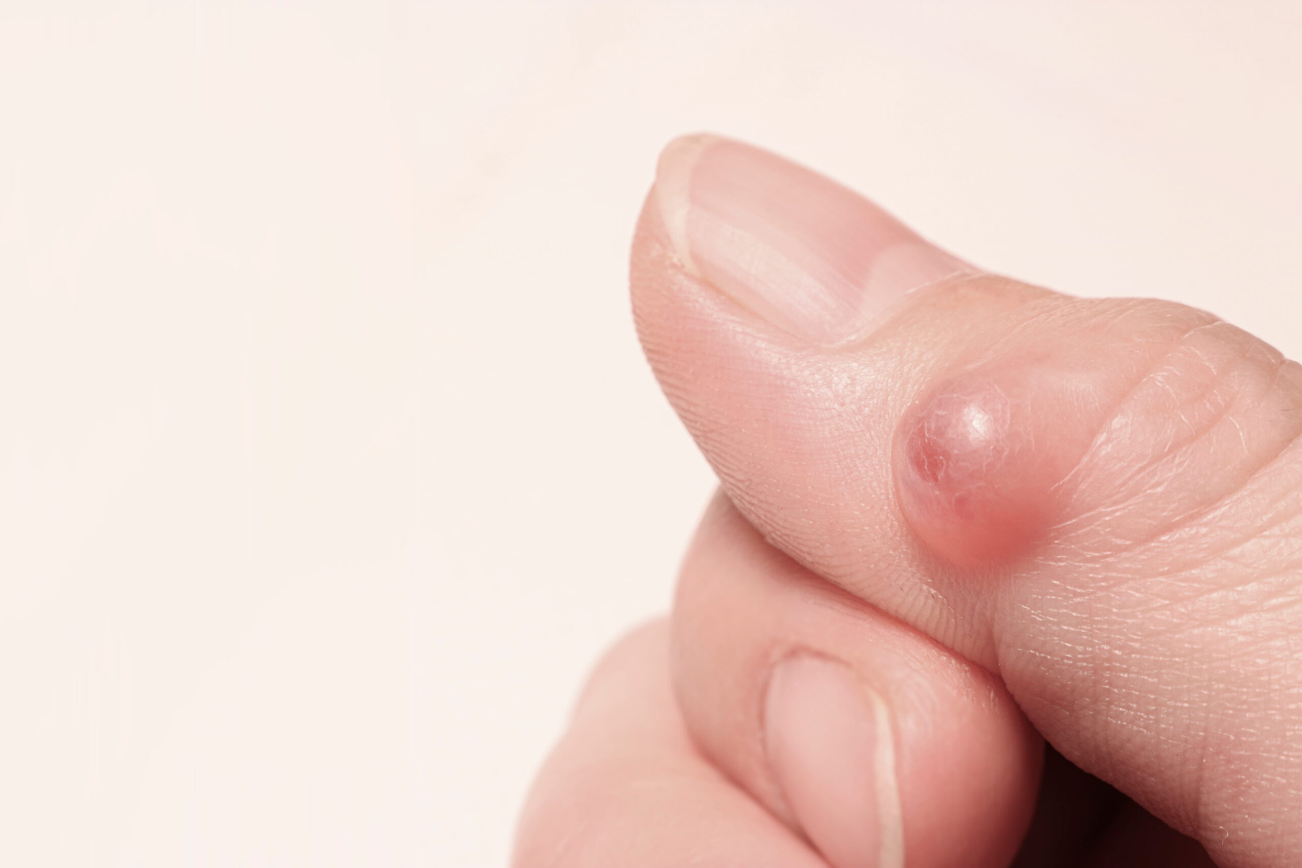 Sebaceous Cyst Removal in Sacramento