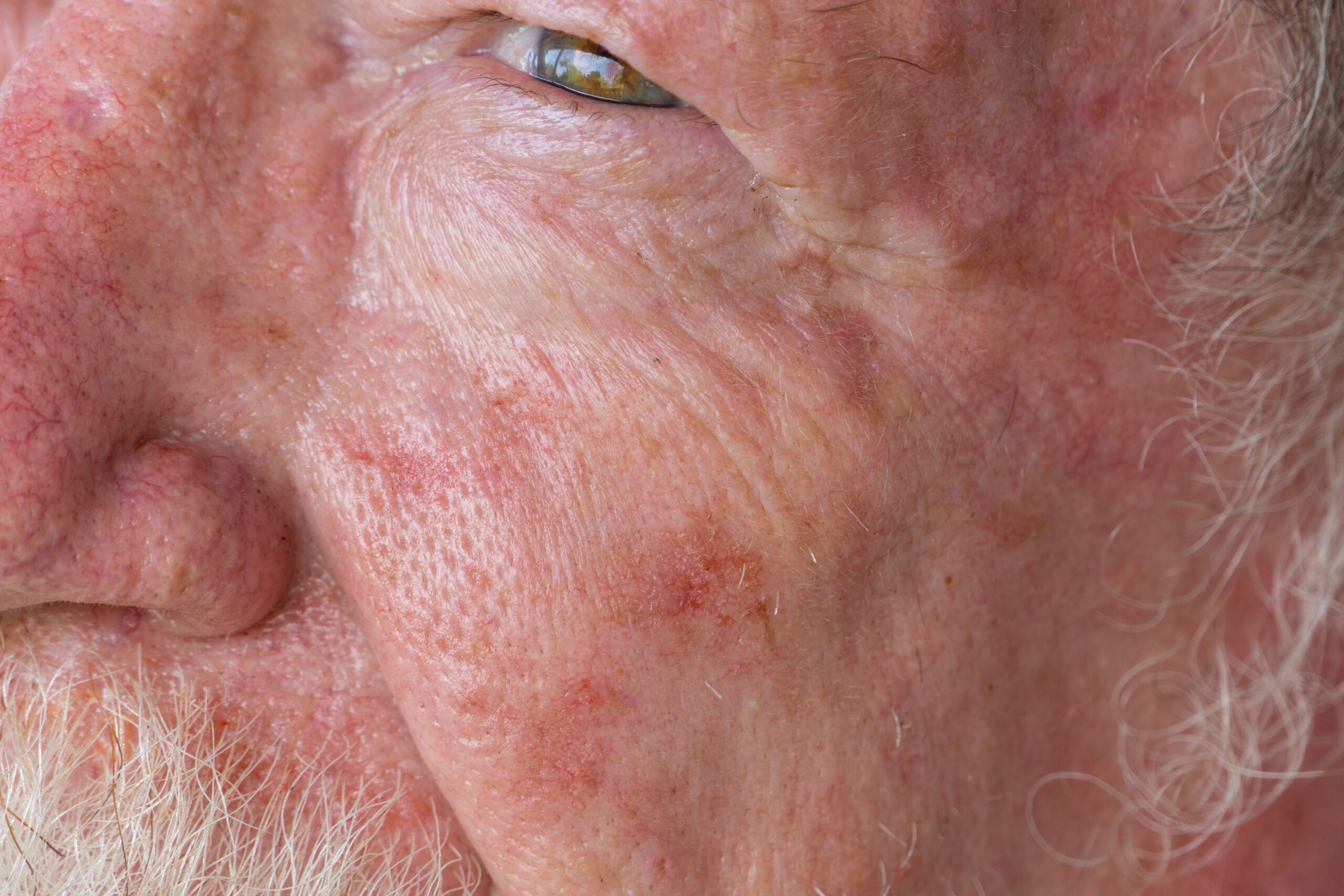 Basal cell carcinoma care in Rocklin, CA