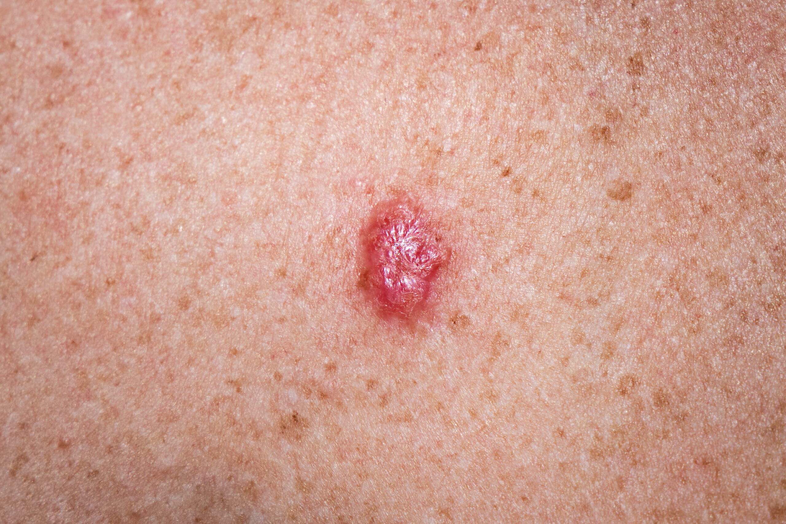 Basal cell carcinoma doctor in Auburn, CA