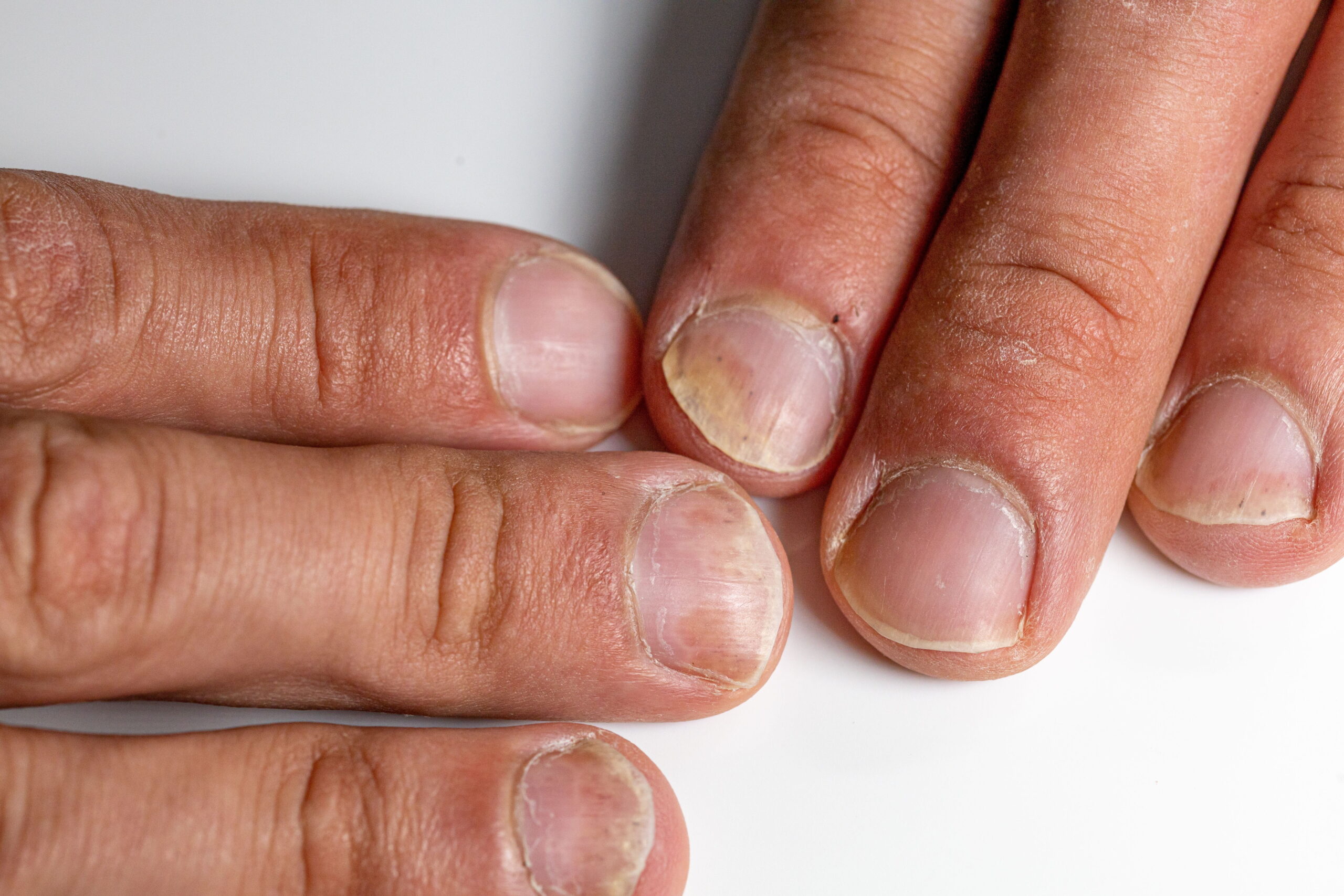 Nail treatment for brittle nails in Auburn, CA